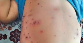डेंगुसँगै स्क्रबटाइफसको थप त्रास बढ्यो