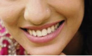 ओठको कालोपन हटाउने प्राकृतिक उपाय