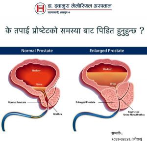 डा. इवामुरा मेमोरियल अस्पतालमा एक महिने प्रोस्टेट शिविर