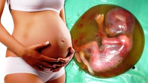 लिङ्ग पहिचान गरी गर्भपतन गराउनेलाई तीन देखि ६ महिनासम्म कैद