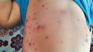 डेंगुसँगै स्क्रबटाइफसको थप त्रास बढ्यो